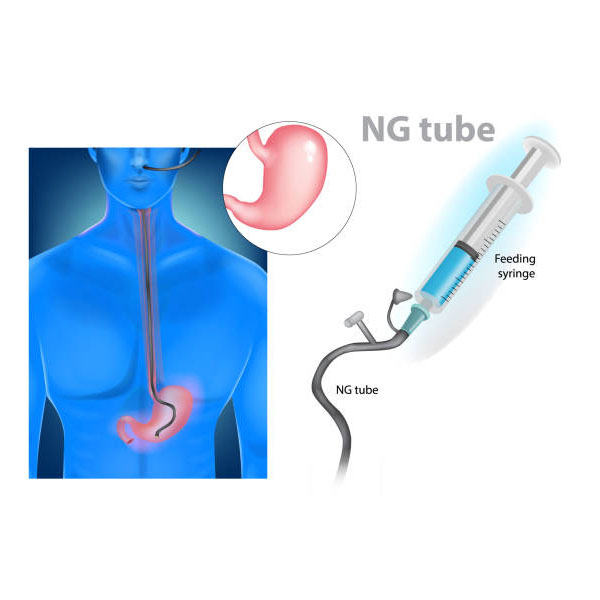 NG Tube (ان جی تیوب) چیست؟