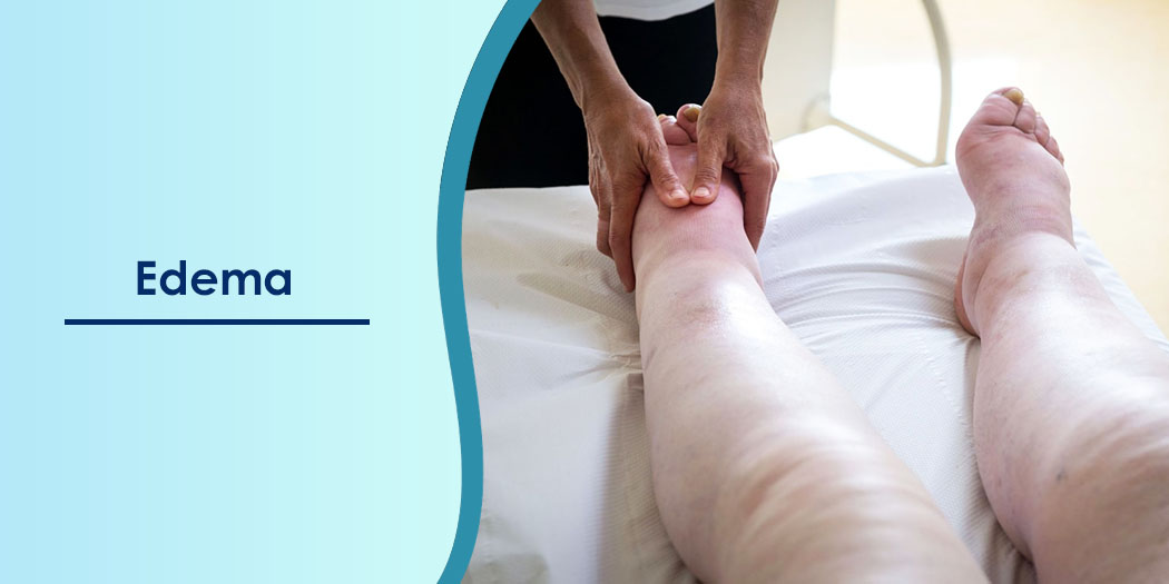 لنف ادم پا (edema)
