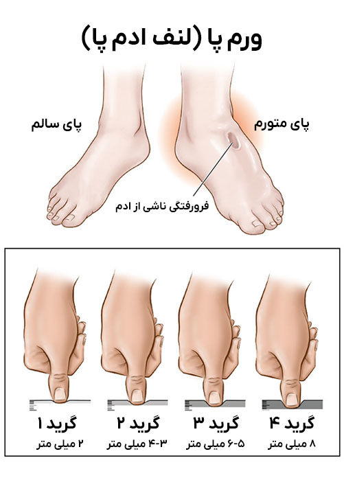 انواع لنف ادم پا (ورم پا)