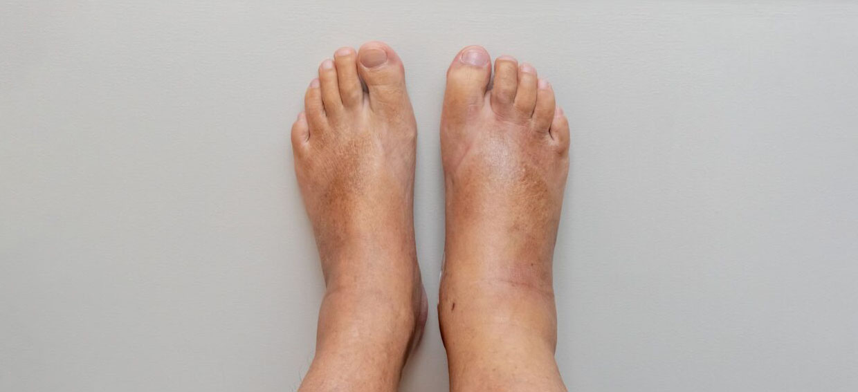 ورم پا در سالمندان