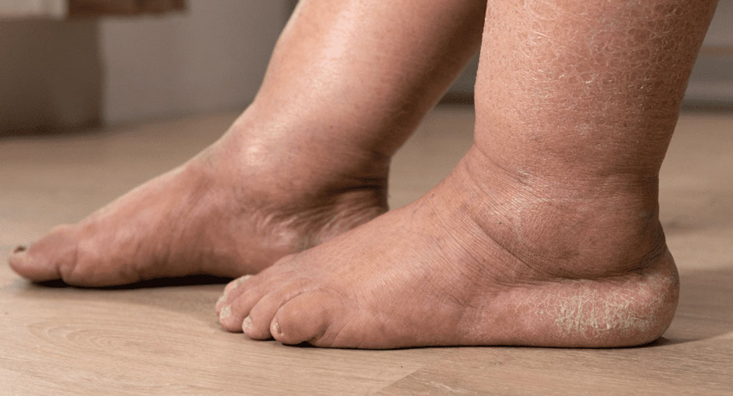 ورم پا در سالمندان