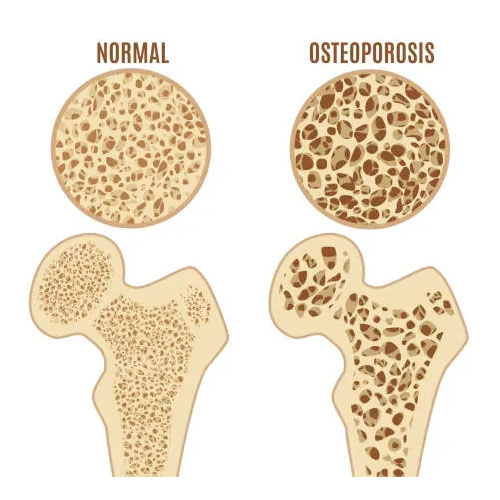 دانسیته استخوانی