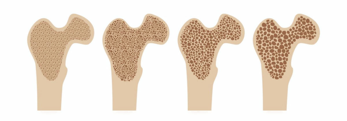 عوامل موثر بر پوکی استخوان